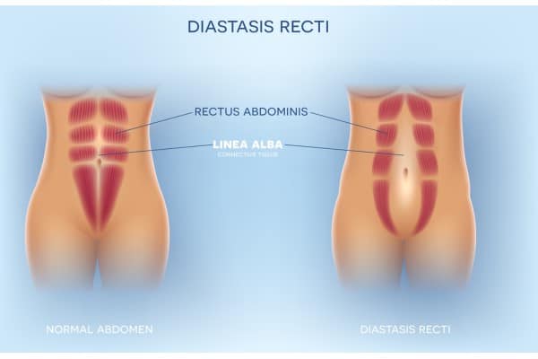What Non-Surgical Options Are Available for Diastasis Recti Corstorphine?