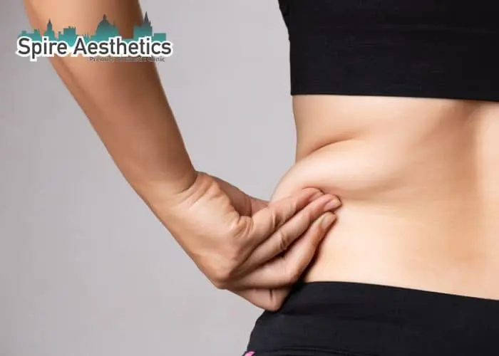 Image of woman pinching fat on their hips Corstorphine. Fat Freezing treatment