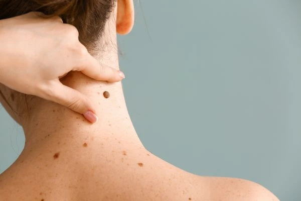 skin blemish removal Corstorphine treatment